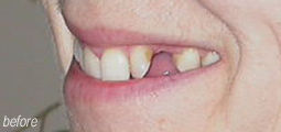 Missing Teeth From Bruce Mayhew - Swindon Dentist