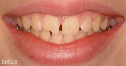 Coloured Composite Teeth From Bruce Mayhew - Swindon Dentist