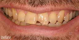 Chipped Teeth From Bruce Mayhew - Swindon Dentist