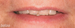Chipped Teeth From Bruce Mayhew - Swindon Dentist