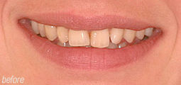 Colour Composite Teeth From Bruce Mayhew - Swindon Dentist