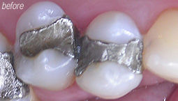 Composite Fillings From Bruce Mayhew - Swindon Dentist