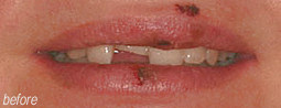 Tooth Repair From Bruce Mayhew - Swindon Dentist