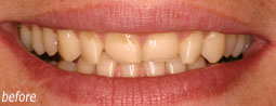 Coca Cola Damage From Bruce Mayhew - Swindon Dentist