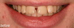 Coloured Composite Teeth From Bruce Mayhew - Swindon Dentist