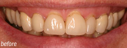 Dental Veneers From Bruce Mayhew - Swindon Dentist