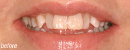 Instanding Teeth From Bruce Mayhew - Swindon Dentist
