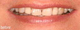 Bridge Replacement From Bruce Mayhew - Swindon Dentist