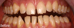6 Month Smiles From Bruce Mayhew - Swindon Dentist