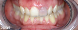 Colour Composite Teeth From Bruce Mayhew - Swindon Dentist