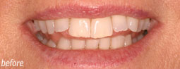 Re-shaping Teeth From Bruce Mayhew - Swindon Dentist