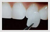 veneers