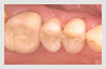 white fillings